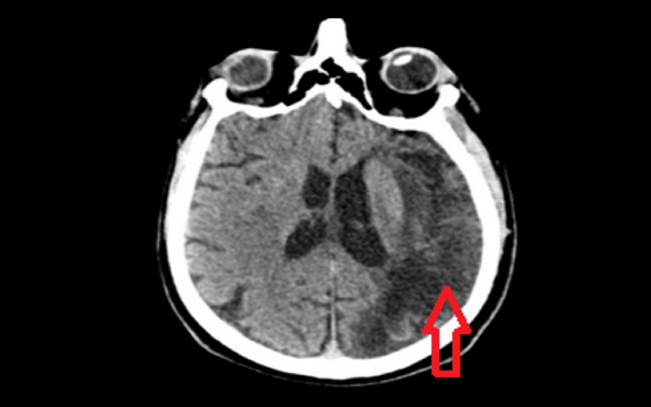 Obraz tomografii komputerowej głowy przedstawiający rozległe ognisko niedokrwienia w lewej półkuli mózgu